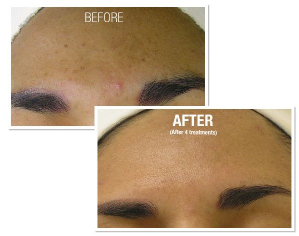 Hydrafacial Before and After in Boston MA