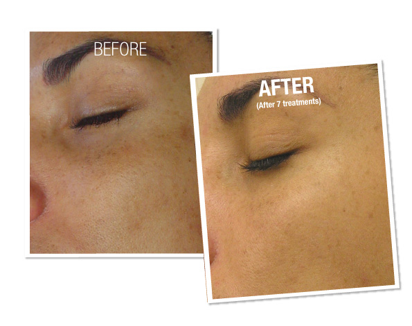 Hydrafacial Before and After in Boston MA