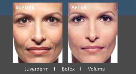 Dermal Fillers and Injectables in Boston & Newburyport, MA