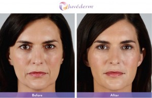 Juvederm Before and After Pictures Boston, MA
