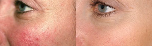Skin Resurfacing Before and After Pictures Boston, MA