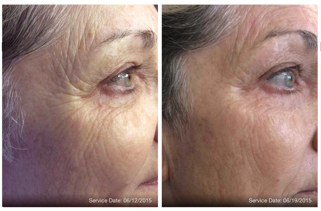 PRP Injections Before and After Pictures Boston, MA