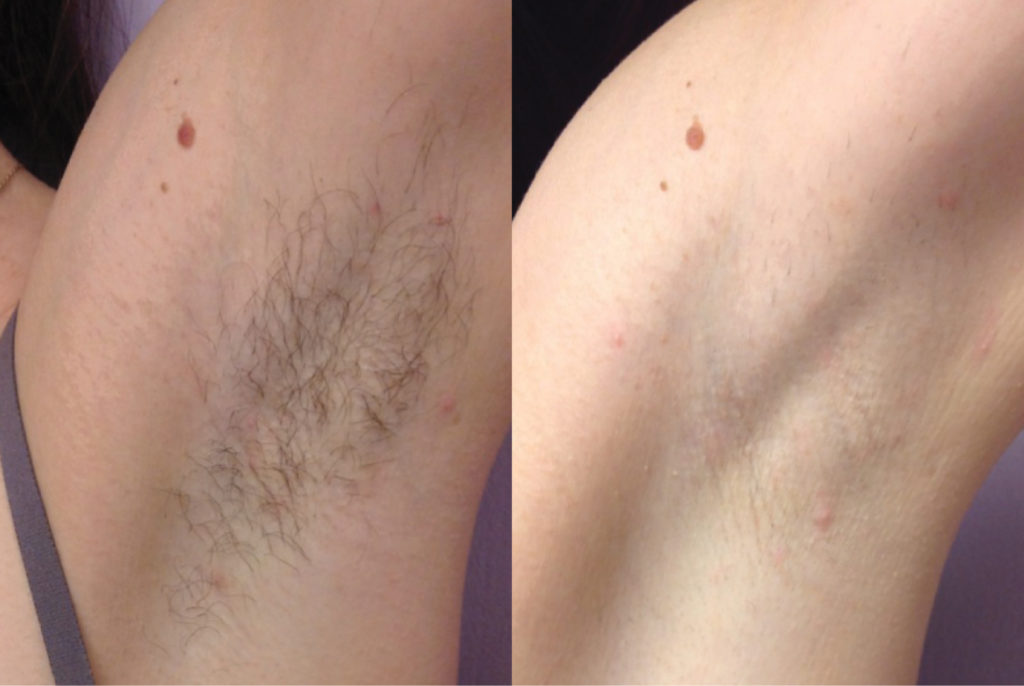 Laser Hair Removal Suite Six Medical Aesthetics