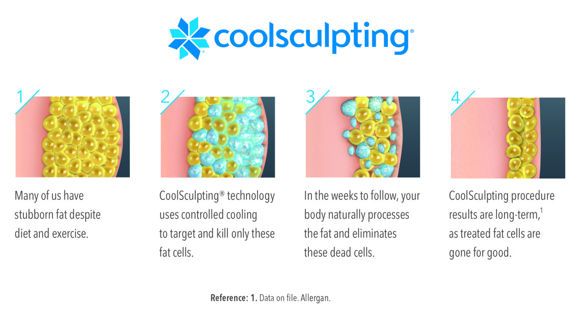 Coolscultping in Boston & Newburyport, MA