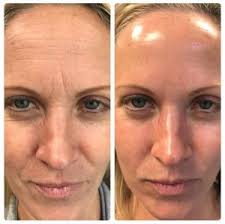 Hydrafacial Before and After in Boston MA