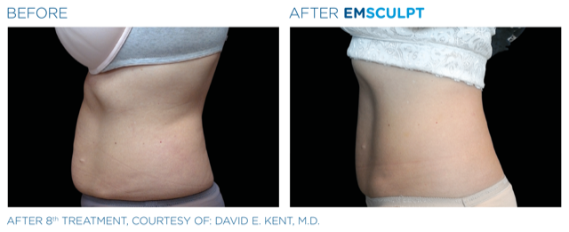 Emsculpt