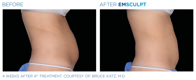 Emsculpt