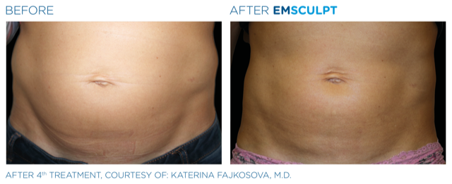 Emsculpt