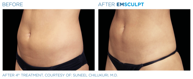 Emsculpt