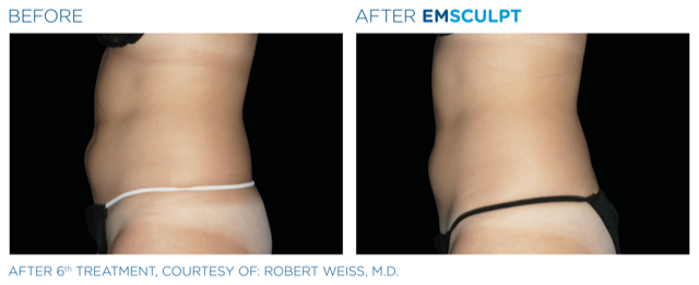 Emsculpt