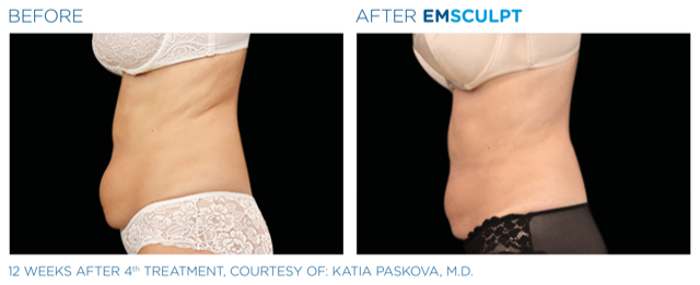 Emsculpt