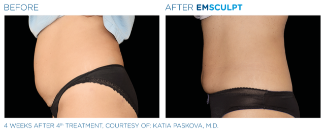 Emsculpt