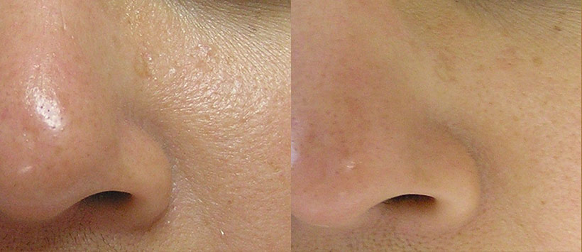 Hydrafacial Before and After in Boston MA